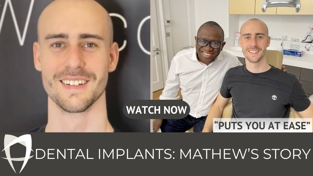 Mathew - Failed Implant Replacement (UL2)