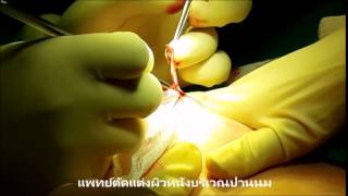 ลดขนาดปานนมเทคนิคใหม่เพื่อซ่อนแผลเป็น