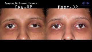 Ptosis Correction by Fasanella Servat Procedure