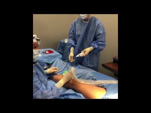 Radiofrequency ablation of great saphenous vein