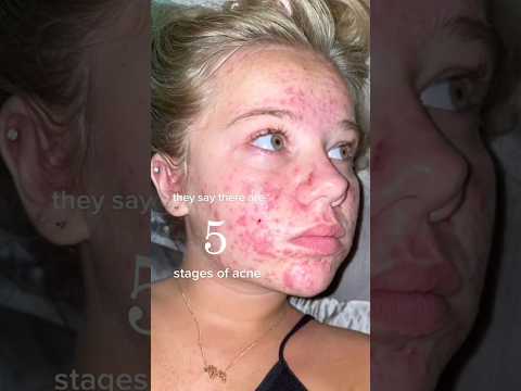 ACNE SKINCARE ROUTINE!😱(follow for more!💗) #acne #acnetreatment #skincare #skincareroutine #beauty