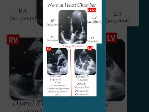 Normal and dilated heart chamber echo l #echo #shorts