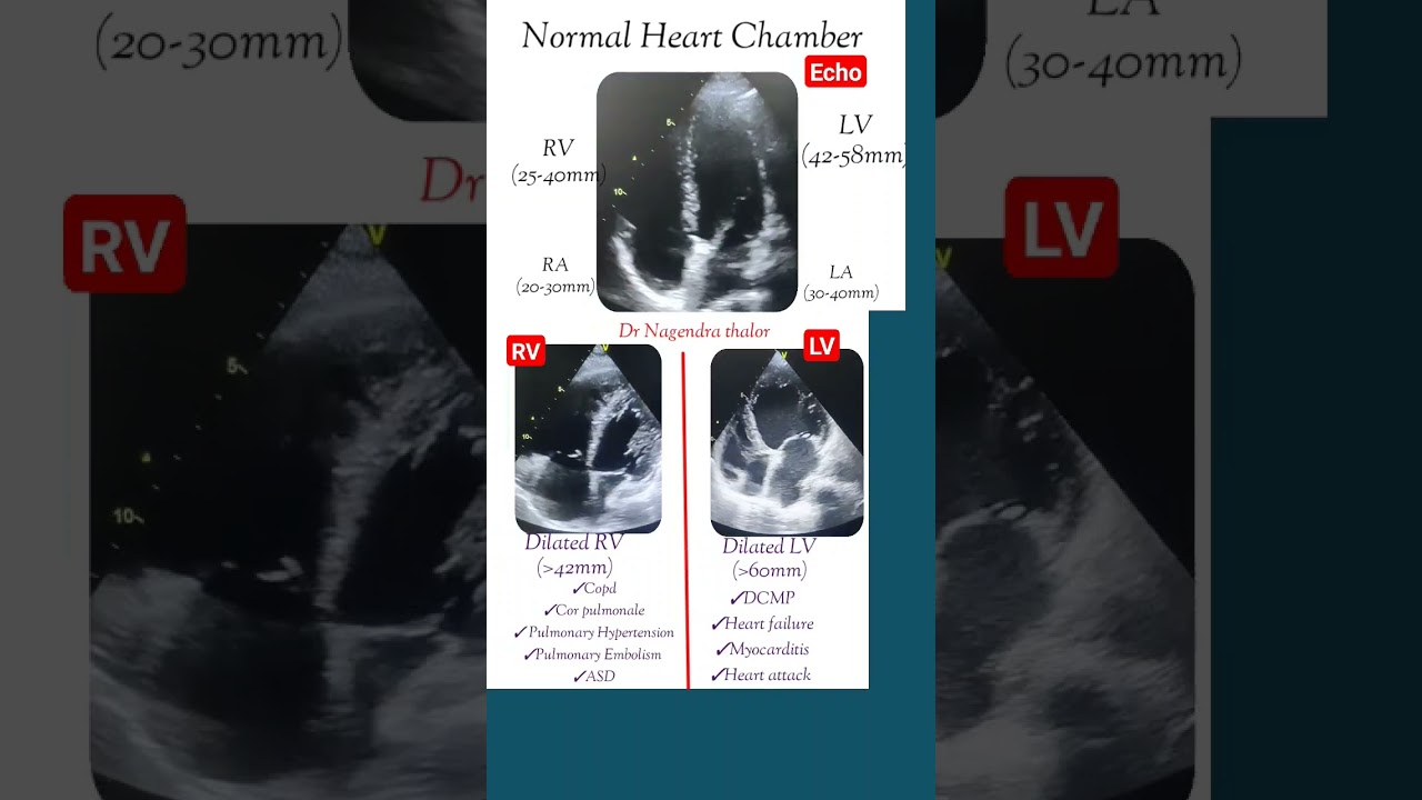 Normal and dilated heart chamber echo l #echo #shorts