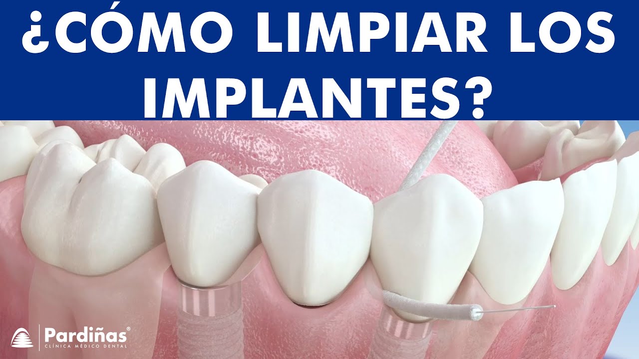 Watch Seda dental e Irrigador - Cómo limpiar prótesis e implantes © Now Seda dental e Irrigador - Cómo limpiar prótesis e implantes ©