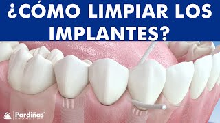 Seda dental e Irrigador - Métodos de limpieza de implantes ©