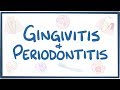 Gingivitis and periodontitis - causes, symptoms, diagnosis, treatment, pathology