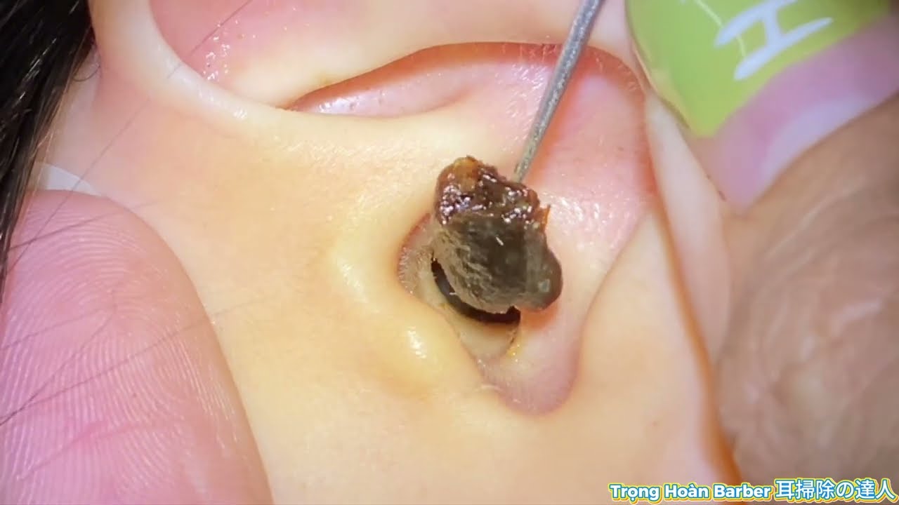 ASMR耳掃除: 驚くほど取れる！耳垢がごっそり…至福の耳かきタイム