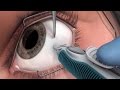 New implant saves vision