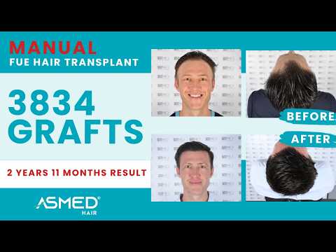 ASMED – Dr. Koray Erdogan – 3834 Grafts | 2 Years 11 Months Results