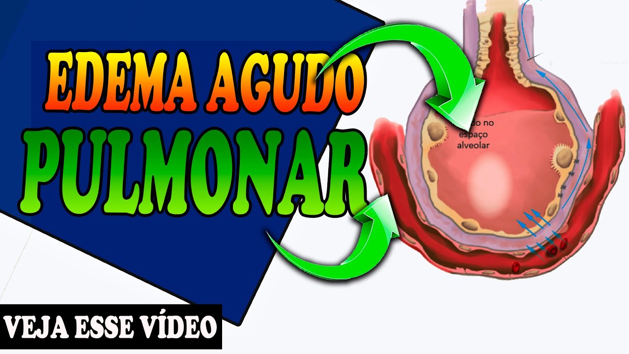 Entenda o Edema Agudo de Pulmão Sintomas e Fisiopatologia | Fisioterapia