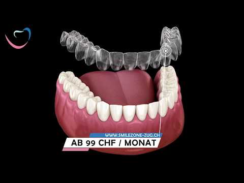 Invisalign Zahnschiene | Gerade Zähne in 3-8 Monate | Wieviel kostet eine transparente Zahnspange?