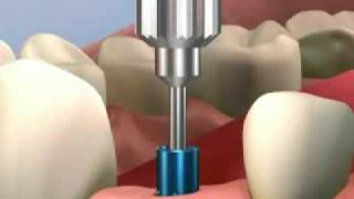 Simulación 3d colocacion de implantes - Clínica Dental Jaume Nin