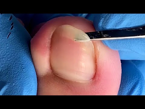 Pedicure Tutorial: Dirty under toenails that needs to be cleaned up in time【Xue Yidao】