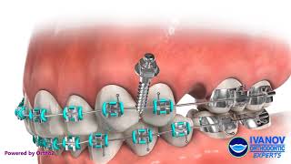 Orthodontic TAD for Mesializing Upper Molar