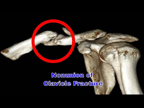 Nonunion of Clavicle Fracture: Causes, Symptoms, and Treatment Options 쇄골 골절 불유합 : 원인, 증상 및 치료 방법