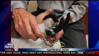 Charlotte Surgeons Complete First Prosthetic Hand with Individual Finger Control