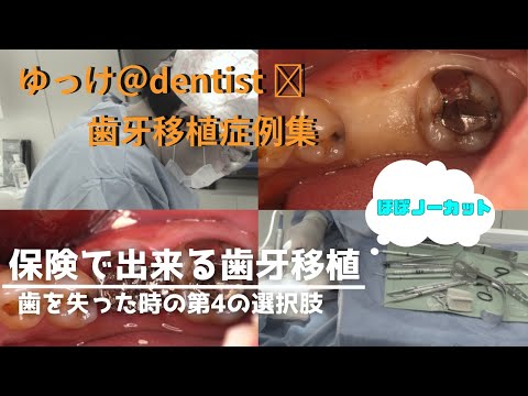生命歯学科 【閲覧注意】ほぼノーカット　親知らずを抜いて歯を救う？！　保険で出来る歯牙移植術