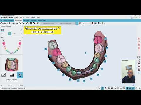 In-house Aligners and DIY solutions - Part 4