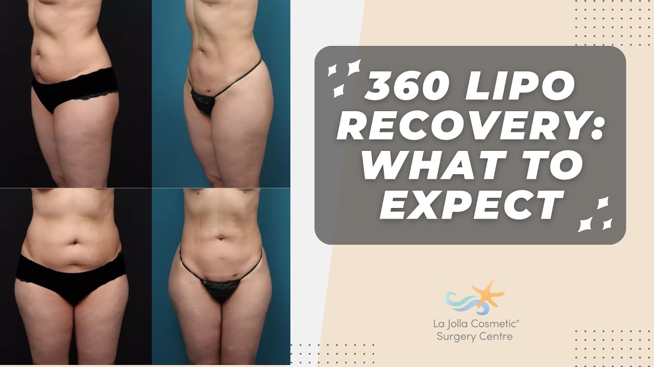 Life After 360 Lipo: What to Expect