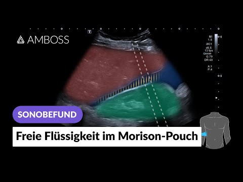 Sonobefund: Freie Flüssigkeit im Morison-Pouch | AMBOSS