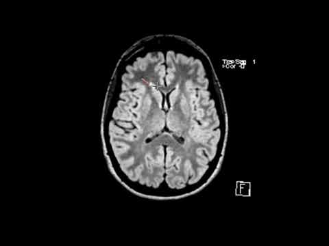 image-Is white matter disease a demyelinating disease?