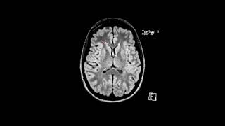 MS white matter lesions | First Look MRI