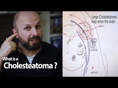 What is Cholesteatoma?
