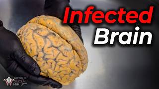 Rabies: One of the Most Deadly Viruses