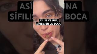 ⚠️ Le salió esto en el LABIO y acabó siendo SÍFILIS