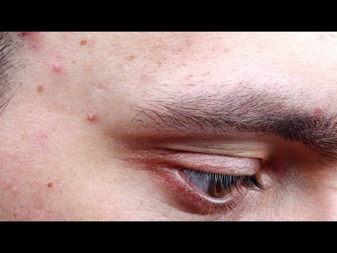 What causes acne and how you can prevent it