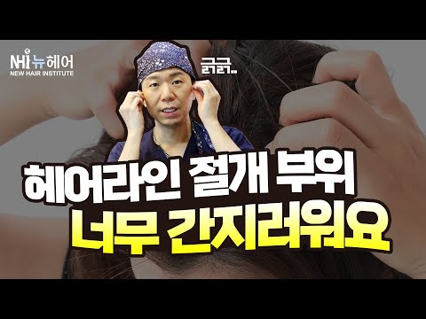 헤어라인 모발이식 1개월, 절개 부위 너무 가려워요ㅣ뉴헤어