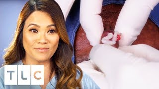 Dr. Lee Removes Joe&#39;s &quot;Third Eye&quot; From The Middle Of His Forehead | Dr. Pimple Popper