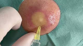 Incision of an abscess in an epidermal cyst