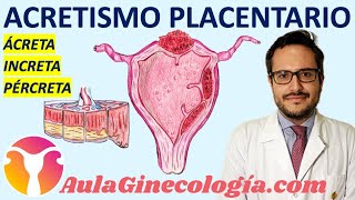 ACRETISMOS PLACENTARIOS: PLACENTA ÁCRETA, ÍNCRETA, PÉRCRETA: MANEJO... - Ginecología y Obstetricia -