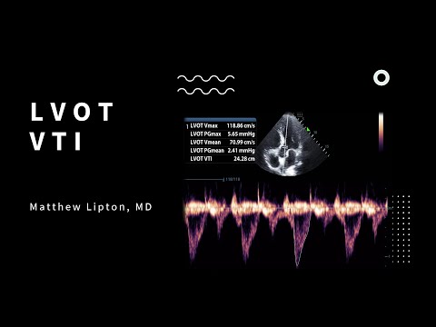 How to use the LVOT VTI to determine fluid responsiveness for the critically ill patient
