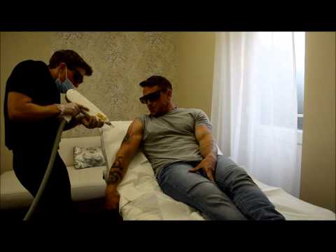 laser tattoo removal at the tattoo removal clinic essex