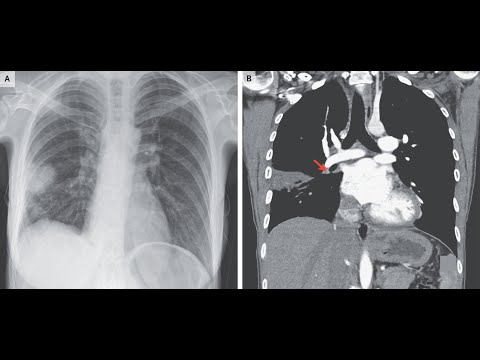 Hampton’s hump als Zeichen eines peripheren Lungeninfarktes