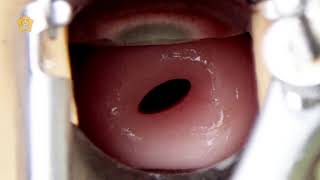 Download lagu Pemeriksaan IVA - dr. Ima Indirayani, Sp. OG mp3