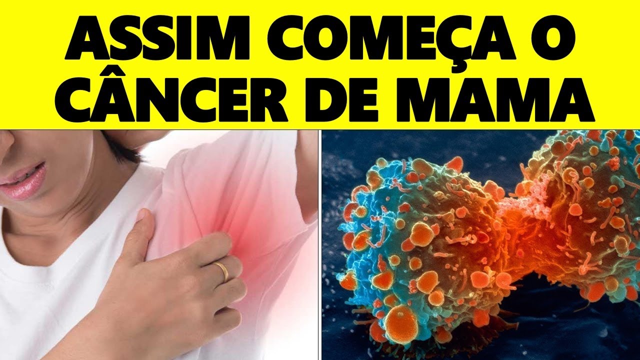 É Assim que o Câncer de Mama Começa e NINGUÉM TOMA CUIDADO – SINAIS e SINTOMAS de Câncer de Mama
