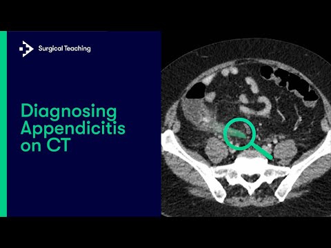 Diagnosing Appendicitis on CT