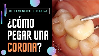 Cómo PEGAR UN DIENTE ROTO o CORONA DENTAL DESPEGADA de forma provisional - #shorts