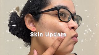 Skin Update 🙂 | Curly Cami Channel