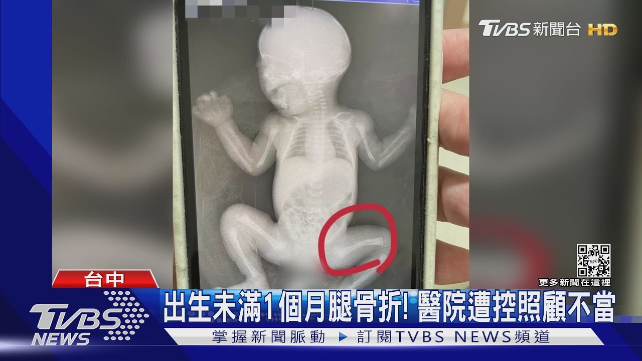 出生未滿1個月腿骨折！　醫院遭控照顧不當