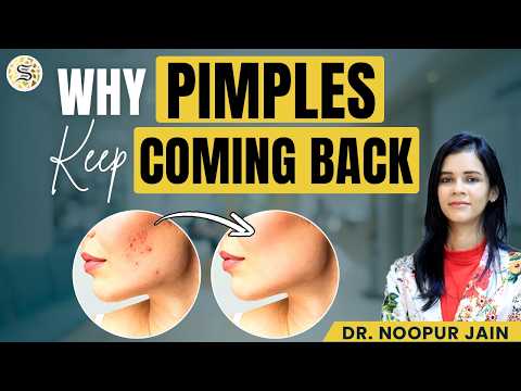 Acne & Pimples Control करने का सही तरीका 🔥 | Best Skincare Routine | Skinzest