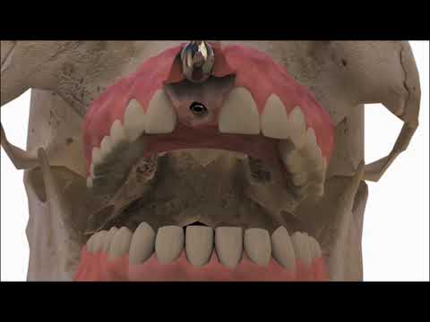 Galimplant Video Pacientes