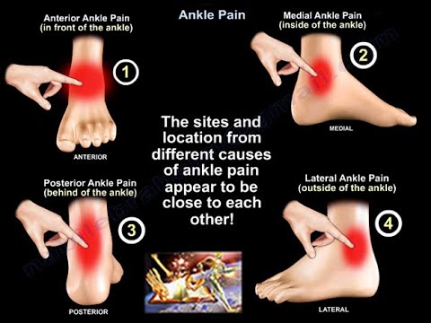 Hogyan kezeljük a térdízületet az artrózis esetén