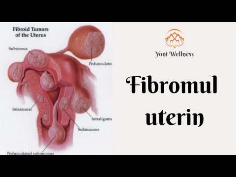 S2. Ep 24 - Fibromul uterin | De la ce apare ? | Simptome | Cum se tratează ? | Cum il prevenim ?