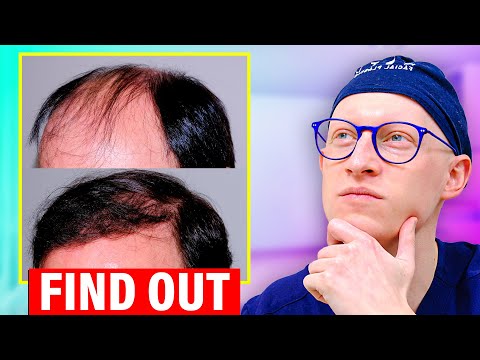Is Hair Transplant For YOU?