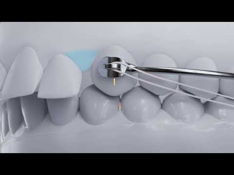 Patient Follow Up 3  - Treatment End | Carriere® Motion 3D
