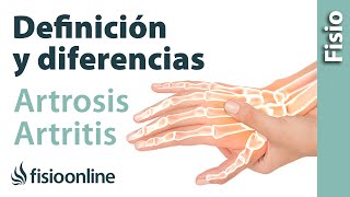 Definición y diferencias entre artrosis y artritis